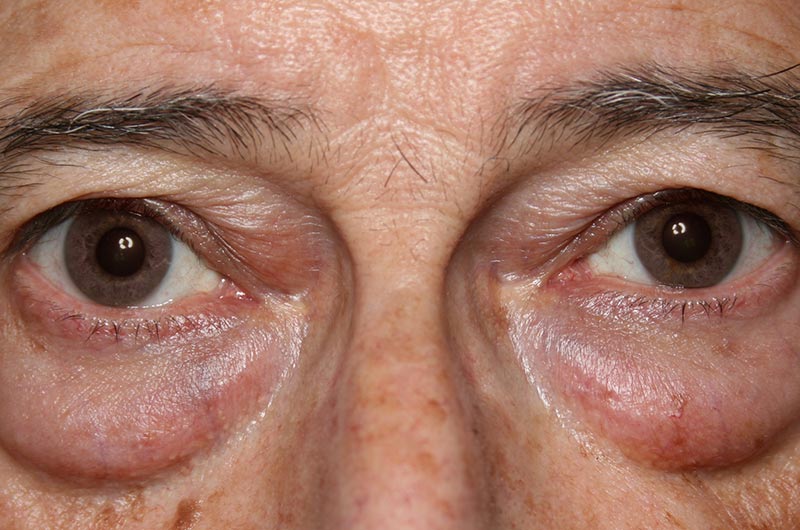 BLEFAROPLASTIA-06-01.jpg BLEFAROPLASTIA-06-01.jpg