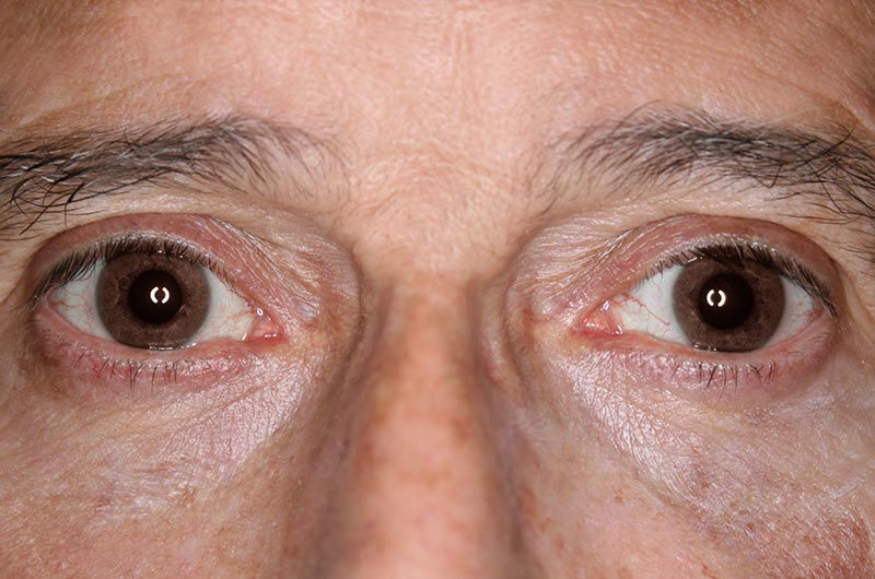 BLEFAROPLASTIA-06-02.jpg